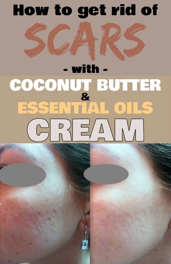 You may not believe but there are natural remedies to get rid of scars. Just like this coconut butter and essential oils cream recipe!