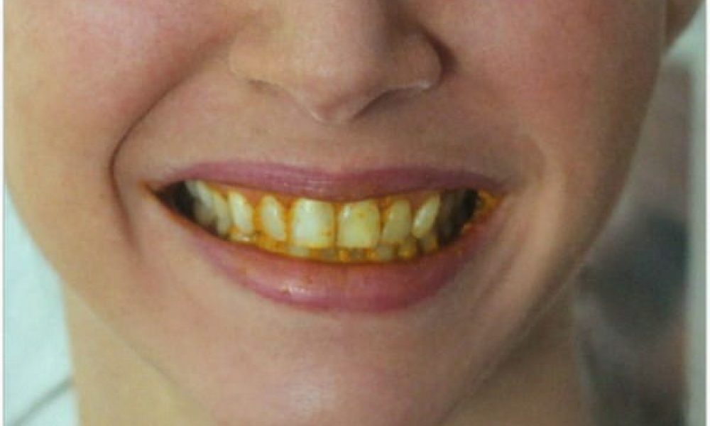 15 NATURAL Ways to Whiten Your Teeth: Homemade Teeth Whiteners