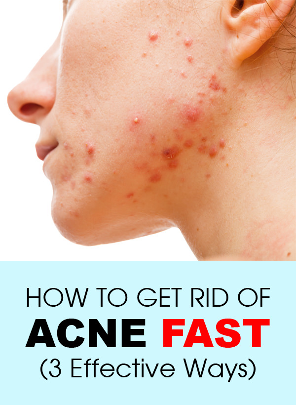 How To Get Rid Of Acne Fast  3 Effective Ways