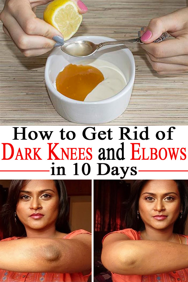 If the dark skin on knees and elbows is bothering you here's how you can rid of it in just 10 days-- learn about the recipe!
