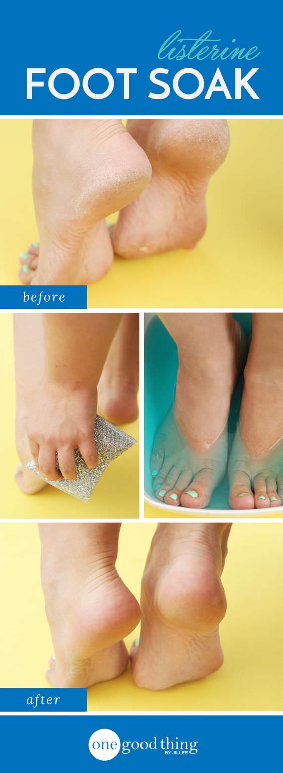 Oh! This is surprising; you can say goodbye to cracked heels now with this effective and easy to make 2 ingredient FOOT SOAK!