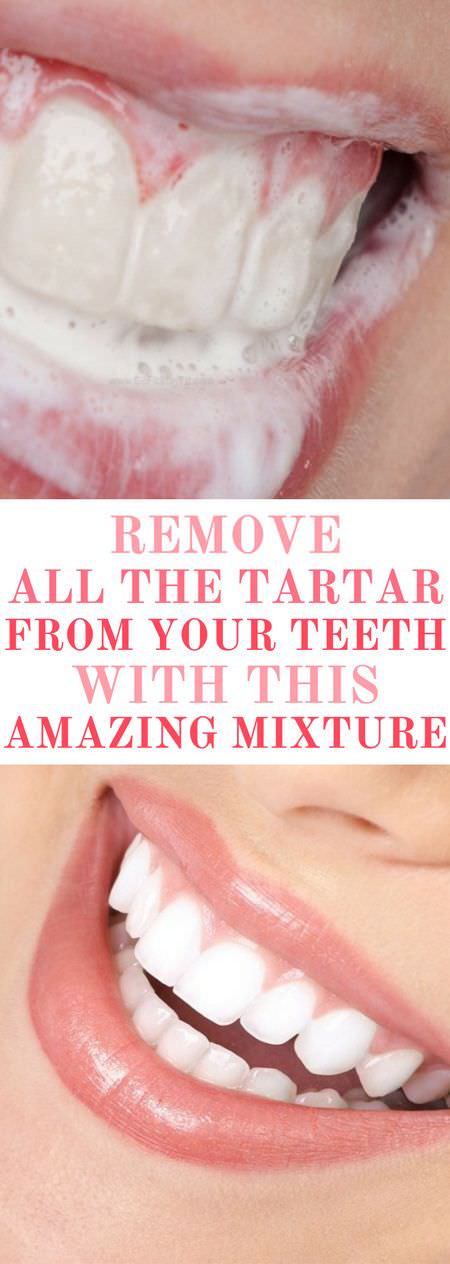 Controlling tartar is an important part of keeping your teeth and gums healthy. Check this simple recipe to get rid of rid of tartar naturally.