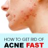How-To-Get-Rid-of-Acne-Fast-3-Effective-Ways